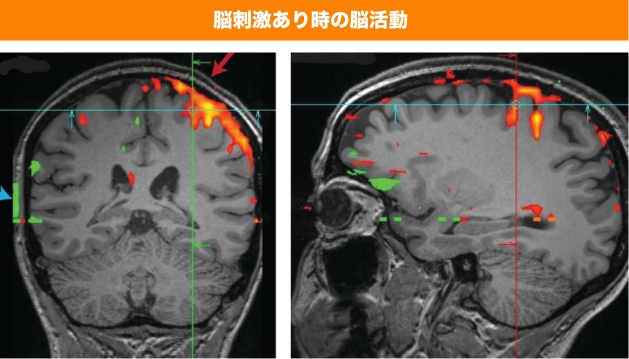 脳刺激あり時の脳活動