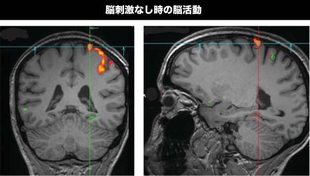 脳刺激なし時の脳活動